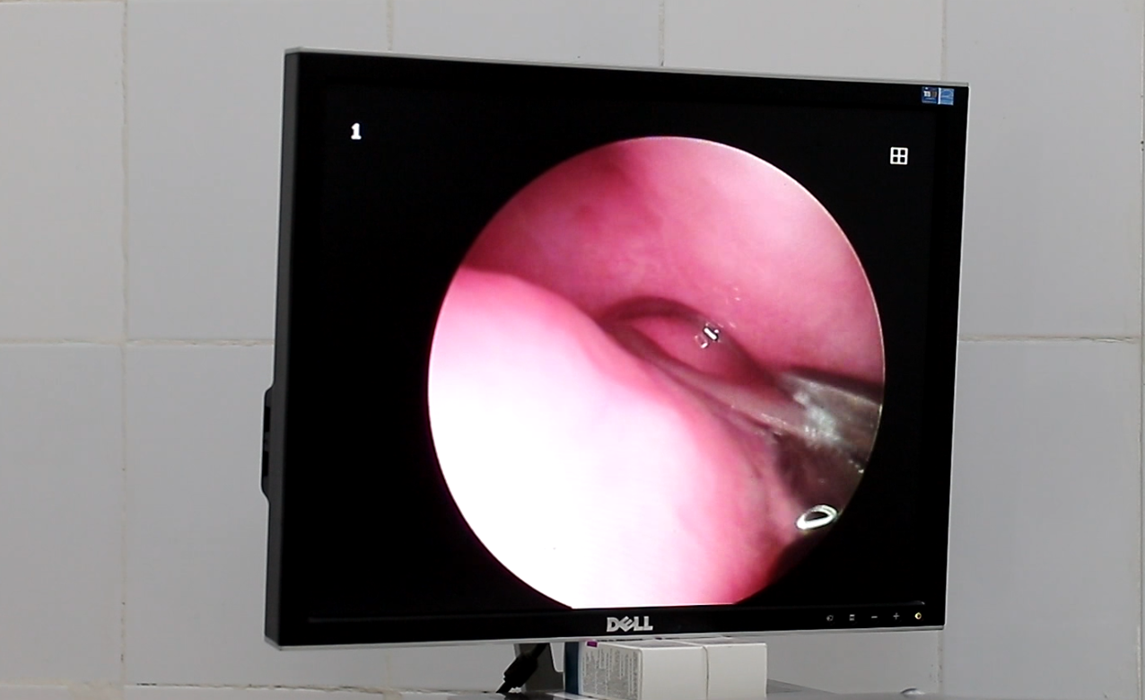 Thực hiện gắp con đỉa qua hình ảnh nội soi