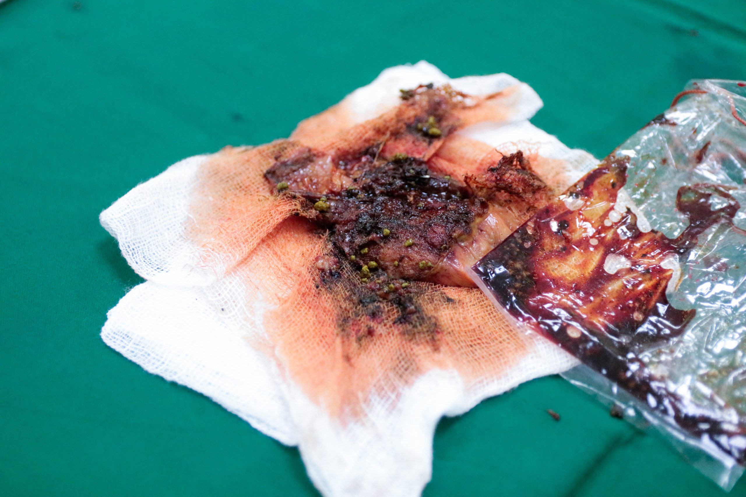 Túi mật chứa nhiều sỏi của người bệnh