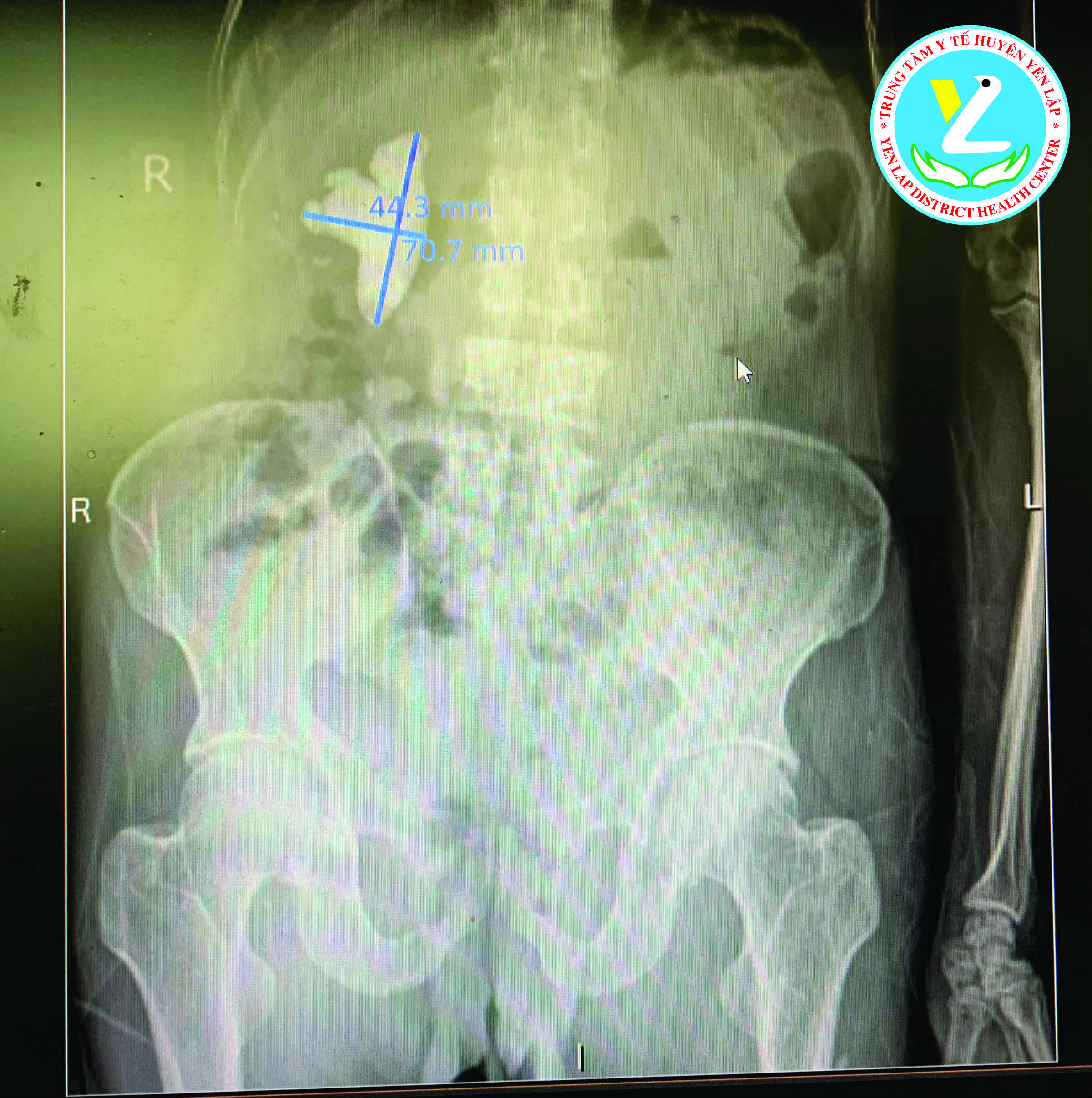 Hình ảnh sỏi thận trên phim cắt lớp vi tính