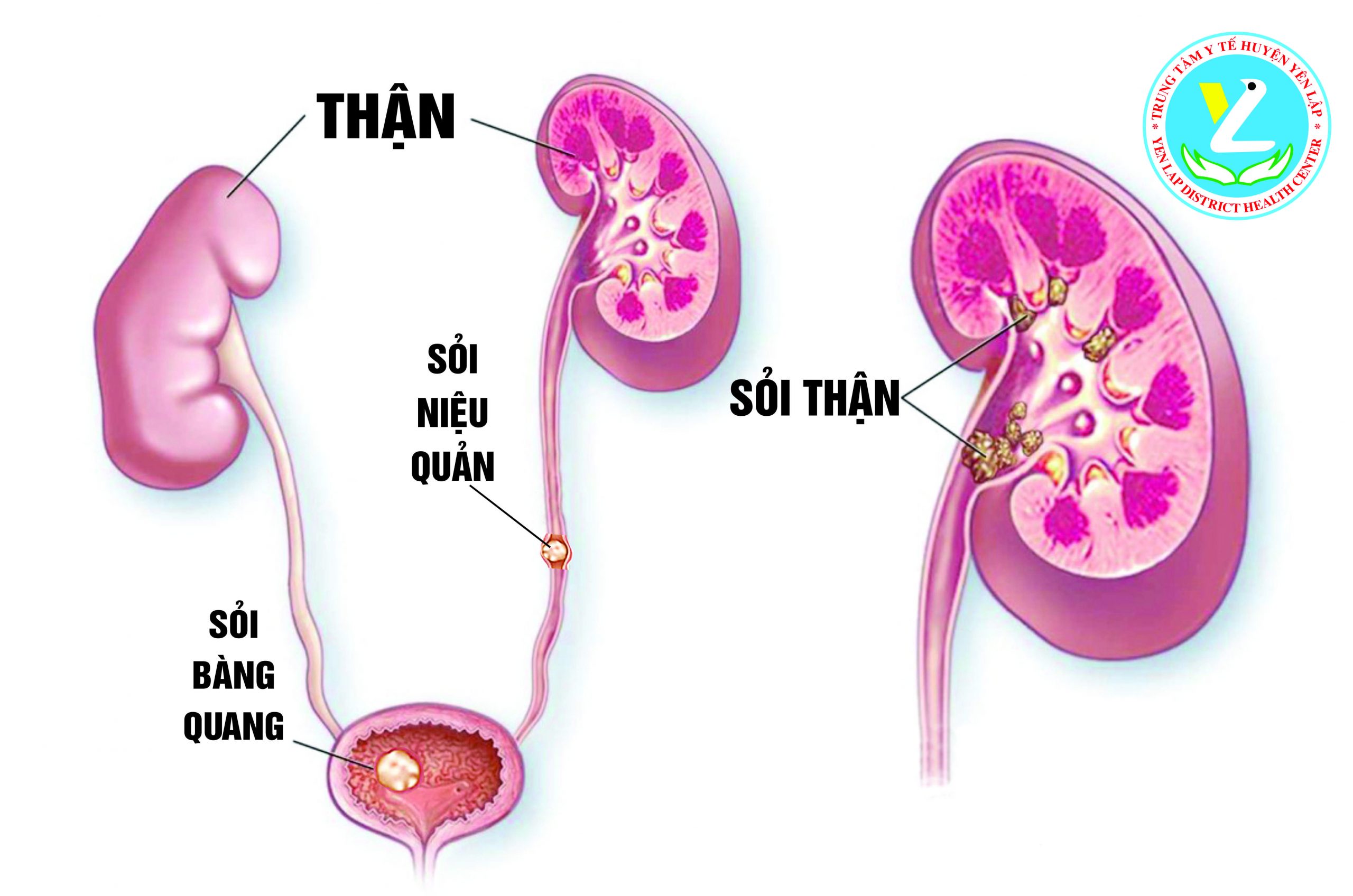 Sỏi tiết niệu nếu không điều trị sớm người bệnh sẽ gặp phải các biến chứng nghiêm trọng