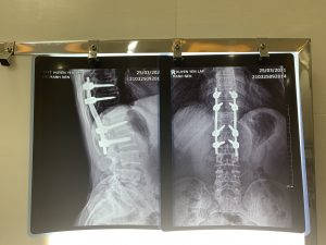 Hình ảnh phương tiện kết hợp xương qua phim X-Quang