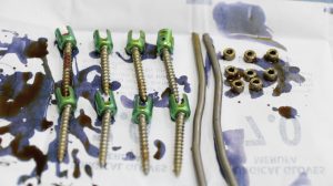 Phương tiện kết hợp xương được phẫu thuật lấy ra từ người bệnh