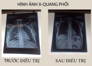 Hình ảnh phim X-Quang phổi người bệnh