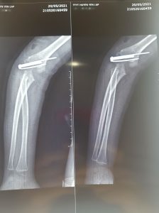 Hình ảnh kim Kirschner cố định ổ gãy