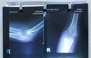 Hình ảnh phim XQ vị trí gãy