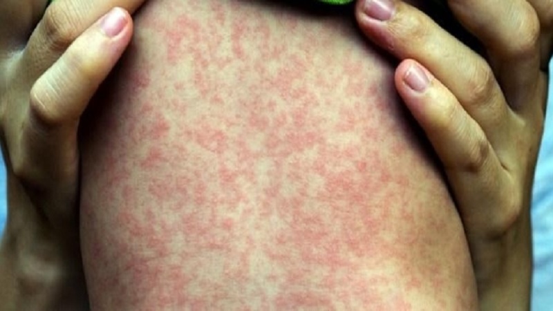 Sởi là một bệnh truyền nhiễm cấp tính, do vi-rút sởi gây ra