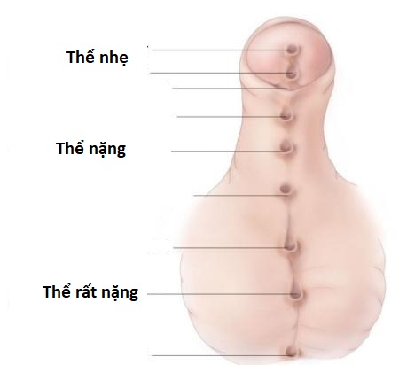 Các mức độ dị tật lỗ tiểu thấp