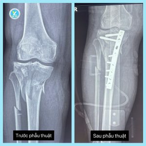 Hình ảnh trước và sau phẫu thuật (Xương chày là xương chịu lực chính, xương mác được điều trị bảo tồn)