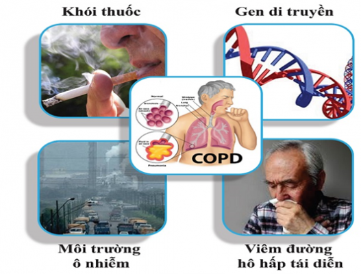 Các nguyên nhân gây nên Bệnh Phổi tác nghẽn mãn tính