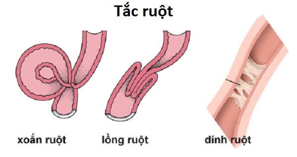 Lồng ruột là nguyên nhân gây đau bụng cấp tính ở trẻ